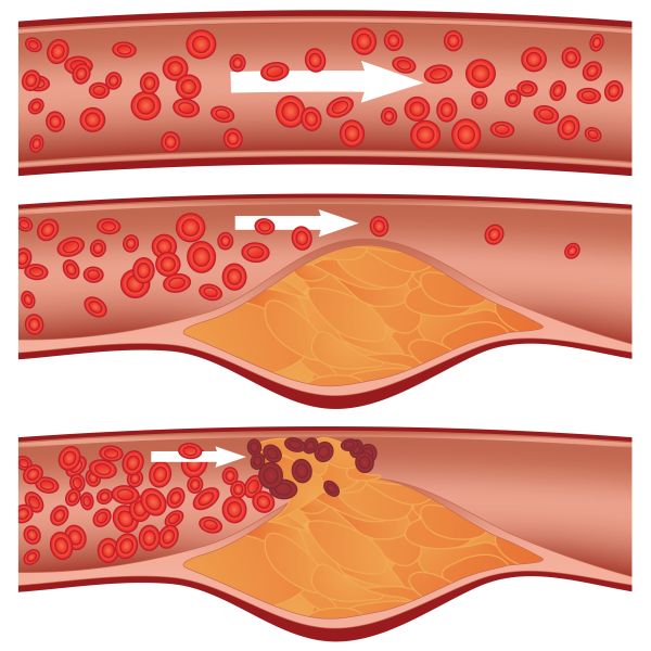 atherosclerosis