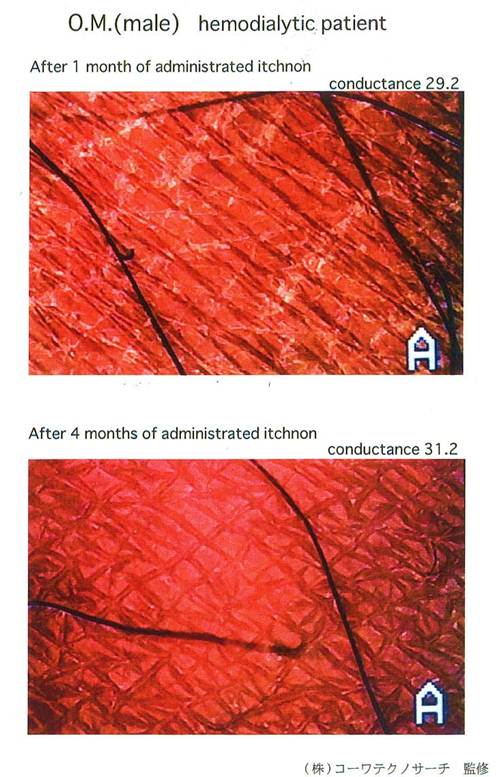 gla on haemodialytic patient