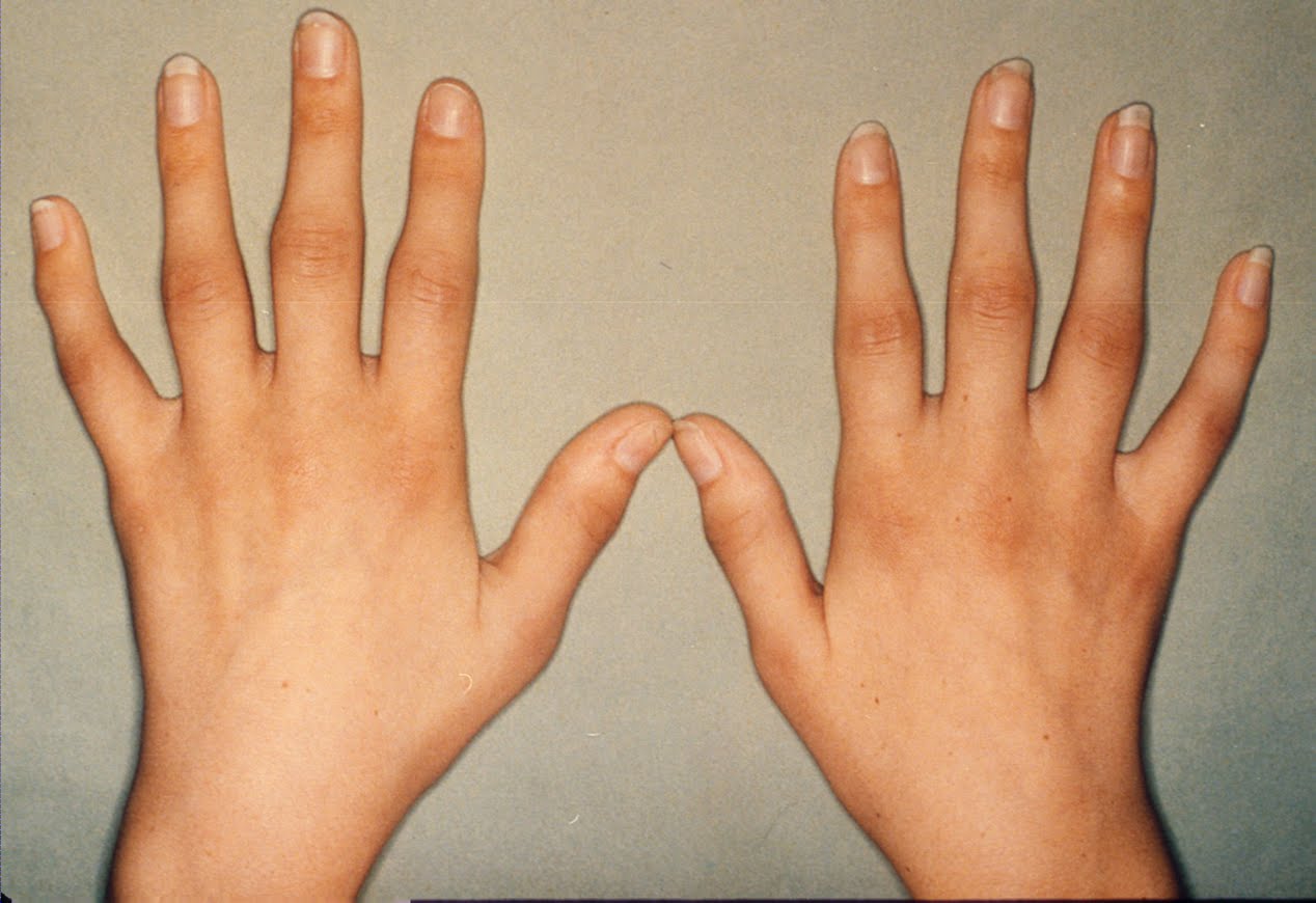 rheumatoid arthritis