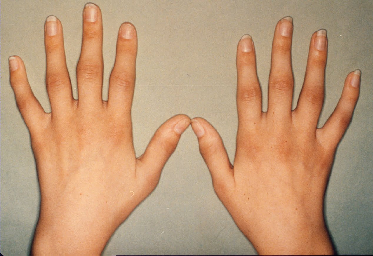 rheumatoid arthritis